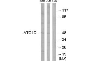 Immunohistochemistry analysis of paraffin-embedded human liver carcinoma tissue using ATG4C antibody. (ATG4C Antikörper  (Internal Region))
