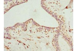 Immunohistochemistry of paraffin-embedded human breast cancer using ABIN7158965 at dilution of 1:100 (Mammaglobin A Antikörper  (AA 1-93))