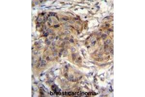 TTC9C Antibody (N-term) immunohistochemistry analysis in formalin fixed and paraffin embedded human breast carcinoma followed by peroxidase conjugation of the secondary antibody and DAB staining. (TTC9C Antikörper  (N-Term))