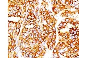 Formalin-fixed, paraffin-embedded human melanoma stained with MART-1 antibody (SPM540). (Rekombinanter MLANA Antikörper)