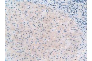 IHC-P analysis of Human Liver Cancer Tissue, with DAB staining. (TLR3 Antikörper  (AA 404-532))