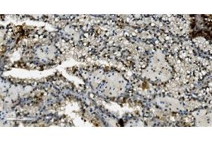 IHC analysis of Transketolase/TKT using anti-Transketolase/TKT antibody (ABIN7598958). (TKT Antikörper  (AA 1-116))