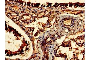Immunohistochemistry of paraffin-embedded human lung tissue using ABIN7147484 at dilution of 1:100 (CDR2 Antikörper  (AA 1-454))