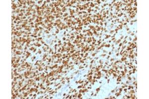 IHC testing of FFPE Ewings sarcoma with NKX2. (Nkx2-2 Antikörper  (AA 1-119))