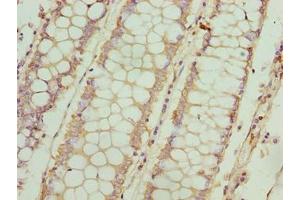 Immunohistochemistry of paraffin-embedded human colon cancer using ABIN7152907 at dilution of 1:100 (FSIP1 Antikörper  (AA 101-400))