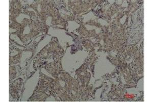 Immunohistochemistry (IHC) analysis of paraffin-embedded Human Breast Carcicnoma using c-Fos Mouse Monoclonal Antibody diluted at 1:200.