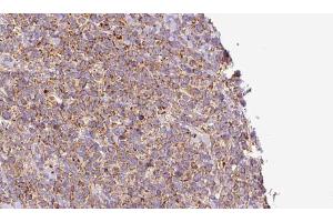 ABIN6273185 at 1/100 staining Human lymph cancer tissue by IHC-P. (WBP2NL Antikörper  (Internal Region))
