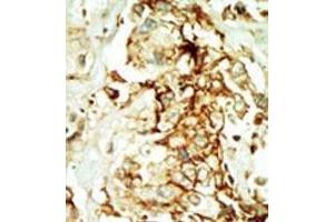 Formalin-fixed and paraffin-embedded human cancer tissue (breast carcinoma) reacted with the primary antibody, which was peroxidase-conjugated to the secondary antibody, followed by DAB staining.