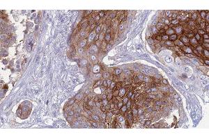 ABIN6277433 at 1/100 staining Human urothelial cancer tissue by IHC-P. (SLC1A4 Antikörper  (C-Term))