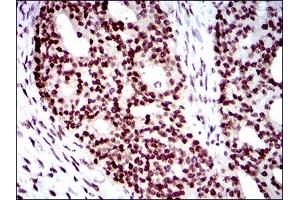 Immunohistochemical analysis of paraffin-embedded ovarian cancer tissues using WHSC2 mouse mAb with DAB staining. (WHSC2 Antikörper  (AA 280-511))
