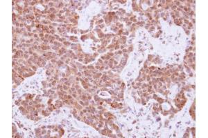 IHC-P Image Immunohistochemical analysis of paraffin-embedded human lung adenocarcinoma, using Cyclin A2, antibody at 1:250 dilution. (Cyclin A Antikörper  (C-Term))