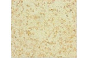 Immunohistochemistry of paraffin-embedded human glioma using ABIN7154046 at dilution of 1:100 (Glutaredoxin 1 Antikörper  (AA 1-106))