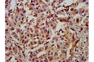IHC image of ABIN7160745 diluted at 1:900 and staining in paraffin-embedded human liver cancer performed on a Leica BondTM system. (FAM174A Antikörper  (AA 1-94))