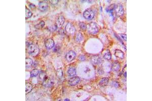 Immunohistochemical analysis of Caspase 1 staining in human lung cancer formalin fixed paraffin embedded tissue section. (Caspase 1 Antikörper  (Center))