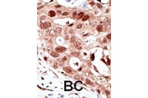 Formalin-fixed and paraffin-embedded human cancer tissue reacted with the primary antibody, which was peroxidase-conjugated to the secondary antibody, followed by AEC staining. (SUMO2 Antikörper  (C-Term))