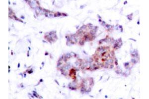 Immunohistochemical analysis of paraffin-embedded human breast cancer tissue using REL polyclonal antibody . (c-Rel Antikörper)