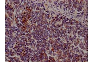 IHC image of ABIN7127588 diluted at 1:100 and staining in paraffin-embedded human lung cancer performed on a Leica BondTM system. (Rekombinanter JAK3 Antikörper)
