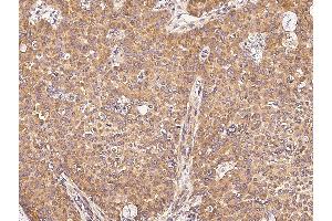 Immunochemical staining of human UBE4A in human breast carcinoma with rabbit polyclonal antibody (0. (Meerschweinchen anti-Kaninchen IgG (Heavy & Light Chain) Antikörper (Alkaline Phosphatase (AP)) - Preadsorbed)