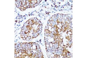 Immunohistochemistry of paraffin-embedded human colon carcinoma using CYCS antibody. (Cytochrome C Antikörper  (AA 1-105))