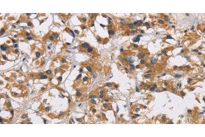 Immunohistochemistry of paraffin-embedded Human thyroid cancer tissue using CYP21A2 Polyclonal Antibody at dilution 1:60