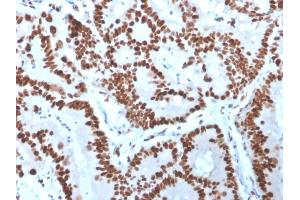 Formalin-fixed, paraffin-embedded human Colon Carcinoma stained with MCM6 Mouse Monoclonal Antibody (MCM6/3000). (MCM6 Antikörper  (AA 228-368))