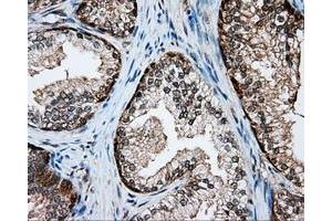 Immunohistochemical staining of paraffin-embedded Adenocarcinoma of colon tissue using anti-SRR mouse monoclonal antibody. (SRR Antikörper)