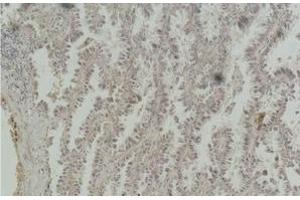 Immunohistochemistry of paraffin-embedded Human lung carcinoma tissue with CREB1 Monoclonal Antibody (CREB1 Antikörper)