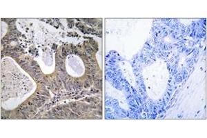 Immunohistochemistry analysis of paraffin-embedded human colon carcinoma tissue, using STEA2 Antibody. (STEAP2 Antikörper  (AA 431-480))
