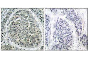 Immunohistochemical analysis of paraffin-embedded human breast carcinoma tissue, using β-Catenin (phospho-Ser37) antibody (E011219). (beta Catenin Antikörper  (pSer37))