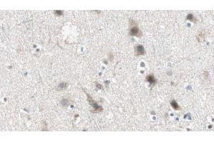 ABIN6274945 at 1/100 staining Human brain cancer tissue by IHC-P. (ABCC3 Antikörper  (Internal Region))