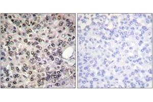 Immunohistochemistry analysis of paraffin-embedded human breast carcinoma, using DDX5/DEAD-box Protein 5 (Phospho-Tyr593) Antibody. (DDX5 Antikörper  (pTyr593))