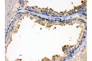 Anti- BMPR1B Picoband antibody,IHC(P) IHC(P): Human Prostatic Cancer Tissue (BMPR1B Antikörper  (AA 14-184))