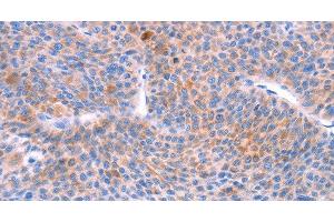 Immunohistochemistry of paraffin-embedded Human liver cancer using AADAC Polyclonal Antibody at dilution of 1:30 (AADAC Antikörper)