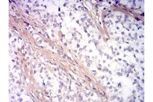 Immunohistochemical analysis of paraffin-embedded bladder cancer tissues using PINK1 mouse mAb with DAB staining. (PINK1 Antikörper  (AA 112-273))
