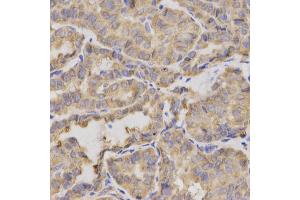 Immunohistochemistry of paraffin-embedded human thyroid cancer using XRCC2 antibody. (XRCC2 Antikörper)