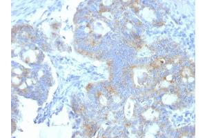 Formalin-fixed, paraffin-embedded human Colon Carcinoma stained with Heparan Sulfate Monoclonal Antibody (A7L6). (HSPG2 Antikörper)