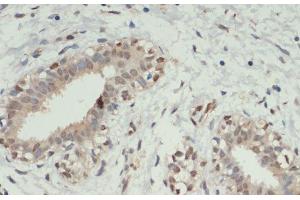 Immunohistochemistry of paraffin-embedded Human breast cancer using KDM6A Polyclonal Antibody at dilution of 1:200 (40x lens). (KDM6A Antikörper)