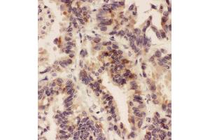 Anti-HSD11B1  antibody, IHC(P)IHC(P): Human Lung Cancer Tissue (HSD11B1 Antikörper  (N-Term))