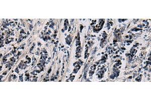 Immunohistochemistry of paraffin-embedded Human breast cancer tissue using SNIP1 Polyclonal Antibody at dilution of 1:80(x200) (SNIP1 Antikörper)