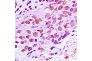 Immunohistochemical analysis of XPA staining in human breast cancer formalin fixed paraffin embedded tissue section.
