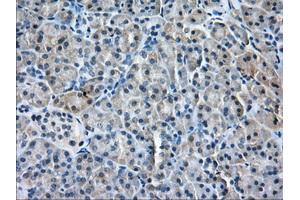 Immunohistochemical staining of paraffin-embedded Adenocarcinoma of Human ovary tissue using anti-PDE4A mouse monoclonal antibody. (PDE4A Antikörper)