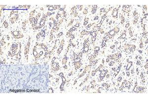 Immunohistochemical analysis of paraffin-embedded human liver cancer tissue. (CaMKIIbeta/gamma/delta Antikörper  (pThr287))