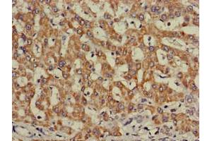 Immunohistochemistry of paraffin-embedded human liver cancer using ABIN7156331 at dilution of 1:100 (Insulin Receptor Antikörper  (AA 1023-1298))