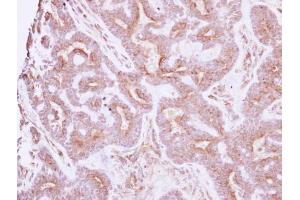 IHC-P Image Immunohistochemical analysis of paraffin-embedded human breast cancer, using NELL1, antibody at 1:250 dilution. (NELL1 Antikörper  (Center))