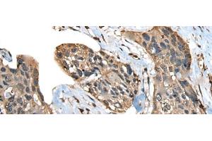 Immunohistochemistry of paraffin-embedded Human esophagus cancer tissue using ATXN3 Polyclonal Antibody at dilution of 1:100(x200) (Ataxin 3 Antikörper)