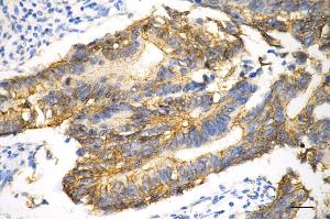 Immunohistochemistry was performed on paraffin-embedded human sigmoid colon carcinoma using catenin beta 1 antibody (ABIN7797931), 1:200).