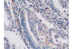 Detection of ENG in Human Endometrial cancer Tissue using Monoclonal Antibody to Endoglin (ENG) (Endoglin Antikörper  (AA 336-450))