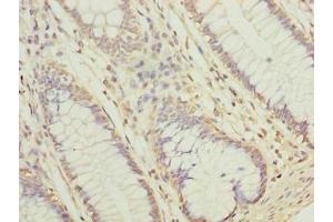 Immunohistochemistry of paraffin-embedded human colon cancer using ABIN7157067 at dilution of 1:100 (NUBPL Antikörper  (AA 39-319))