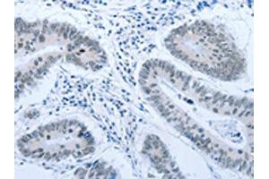 The image on the left is immunohistochemistry of paraffin-embedded Human colon cancer tissue using ABIN7189621(ACIN1 Antibody) at dilution 1/30, on the right is treated with synthetic peptide. (ACIN1 Antikörper)