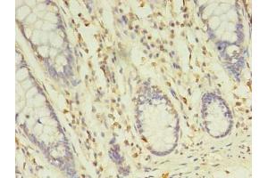 Immunohistochemistry of paraffin-embedded human colon cancer using ABIN7173349 at dilution of 1:100 (TREML2 Antikörper  (AA 19-268))